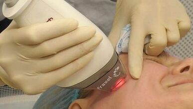 Nola egiten da zatikako larruazala gaztetzeko