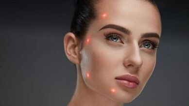 Zer da larruazaleko gaztetze zatikatua