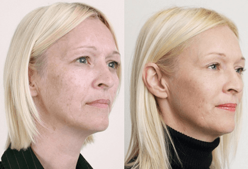 Peeling ertaina fruta azidoekin